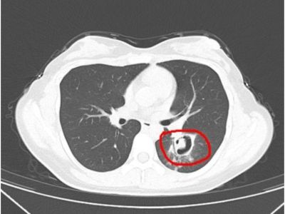 整理发霉衣柜患上肺炎？长沙此前也有类似患者